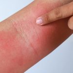 چگونه استفاده از این ملحفه‌ها می‌تواند به ایجاد اگزما در پوست منجر شود؟