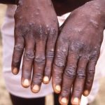 الارم در قلب آفریقا: شیوع بیماری مرگبار شبحی در سایه!