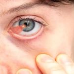 درمان و نشانه‌های ناخنک چشم؛ رازهایی که باید بدانید