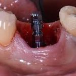 چقدر طول می‌کشد تا ایمپلنت دندان تعویض شود؟ بررسی عمر مفید ایمپلنت‌های دندانی