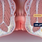 راه‌های درمان زخم داخل مقعد و علائم آن