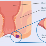 آبسه آنورکتال، علائم و راه‌های درمان