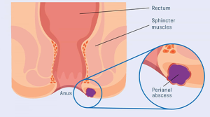 آبسه آنورکتال، علائم و راه‌های درمان